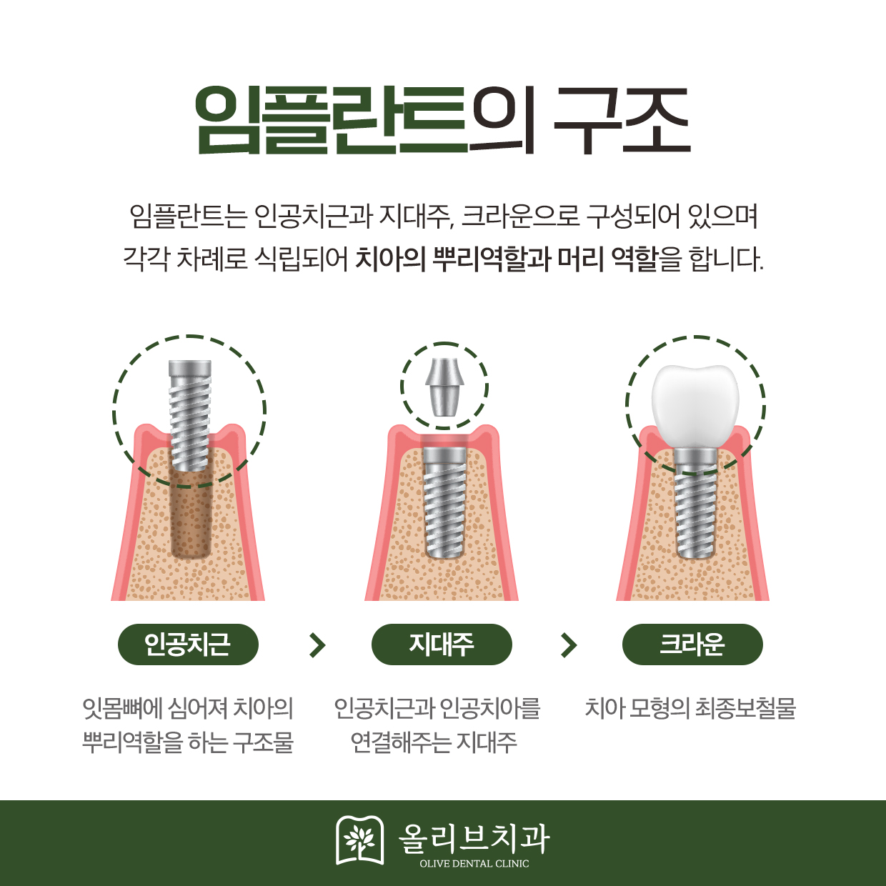 올리브치과 임플란트