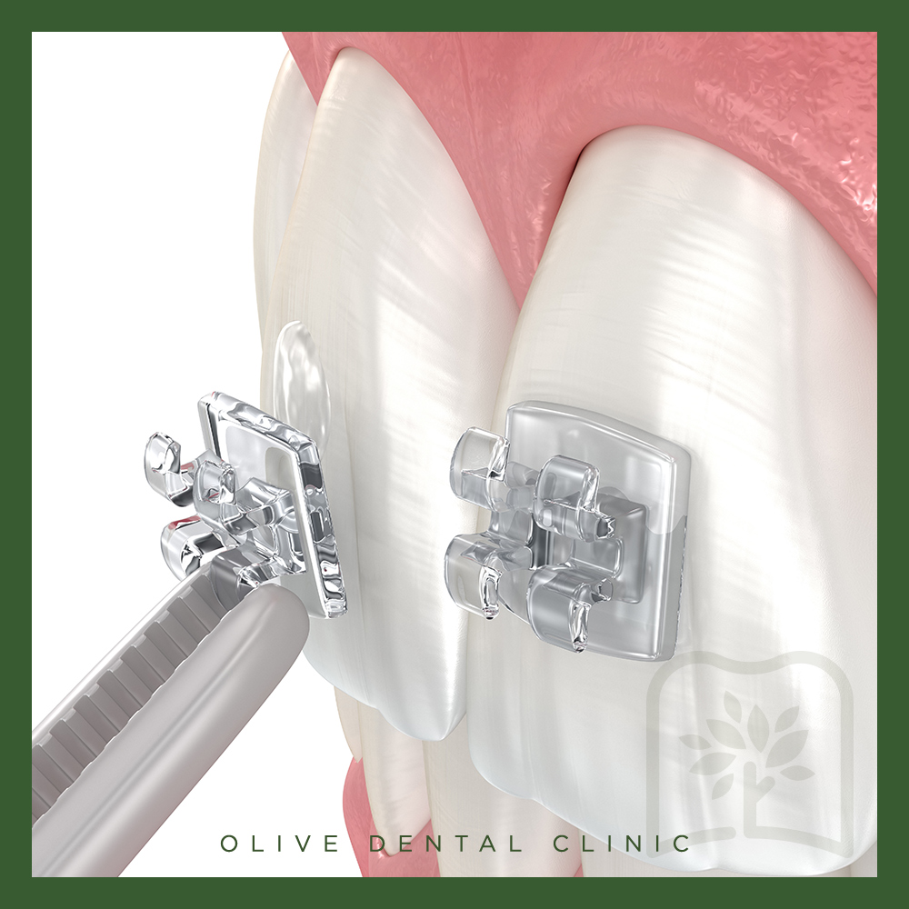 올리브치과 치아교정