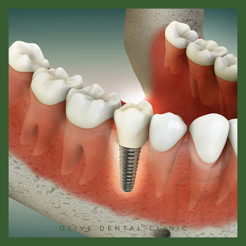 올리브치과 임플란트