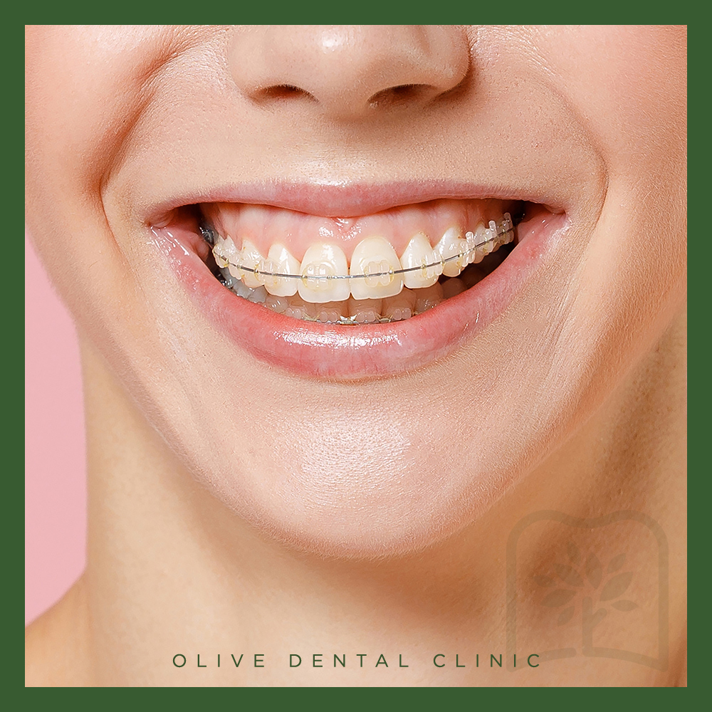 올리브치과 치아교정