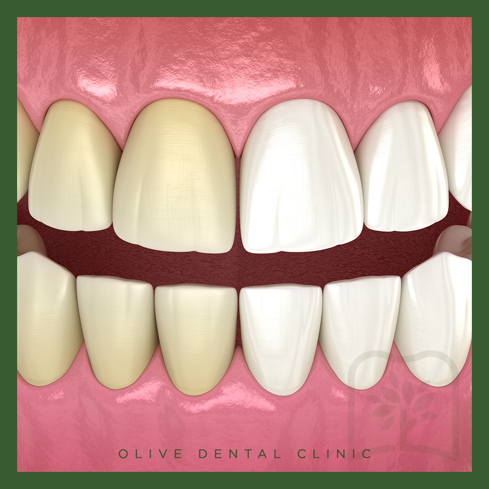 올리브치과 치아미백