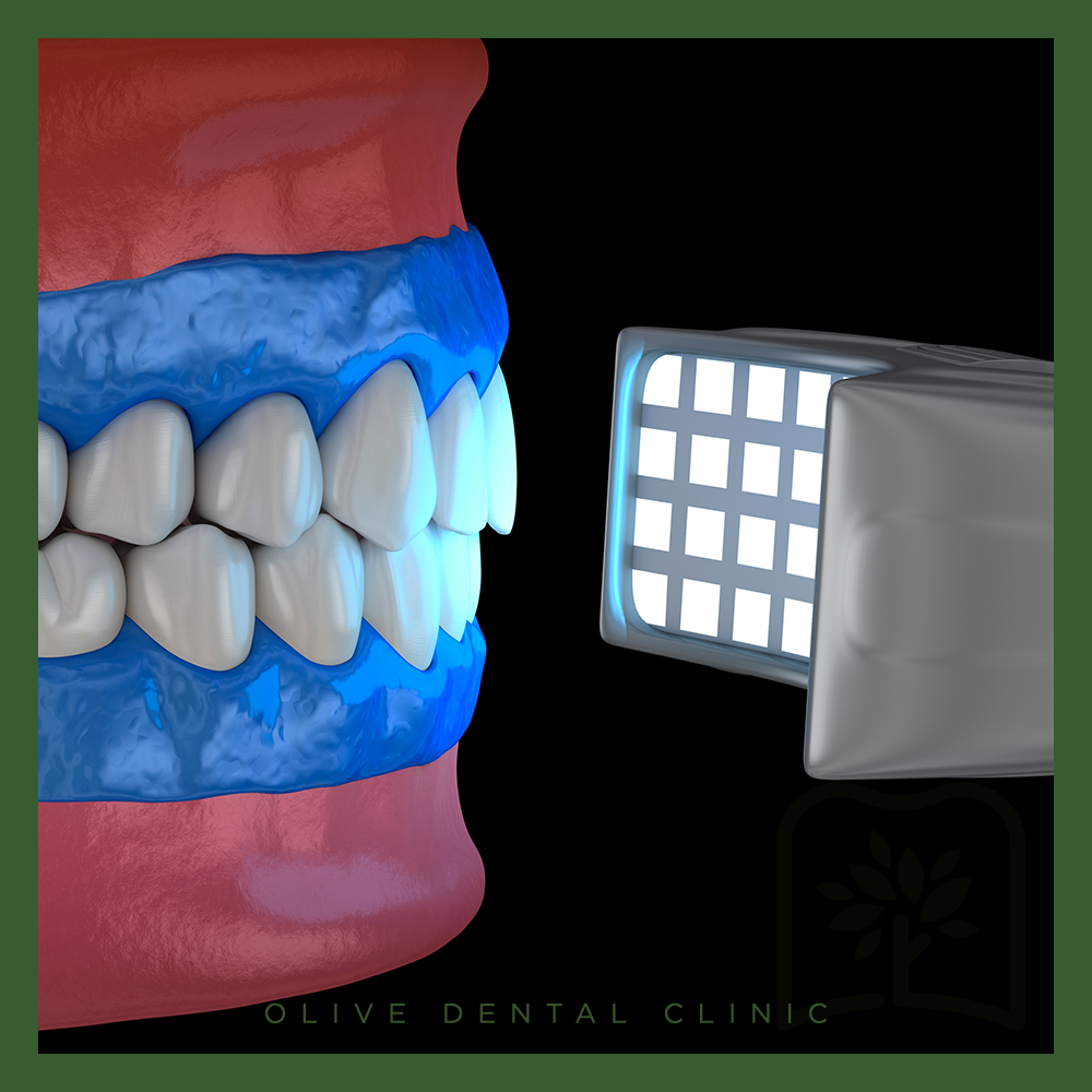 올리브치과 치아미백