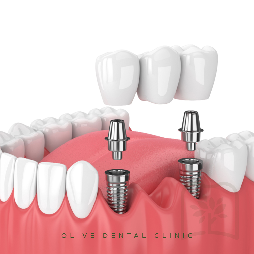 올리브치과 임플란트