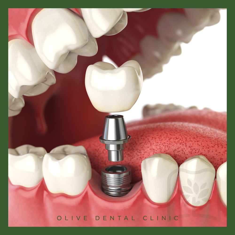 올리브치과 임플란트