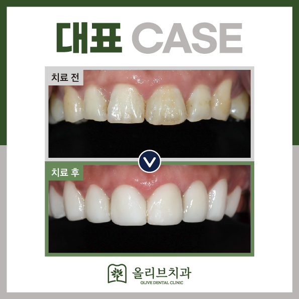 올리브치과 미니쉬솔루션