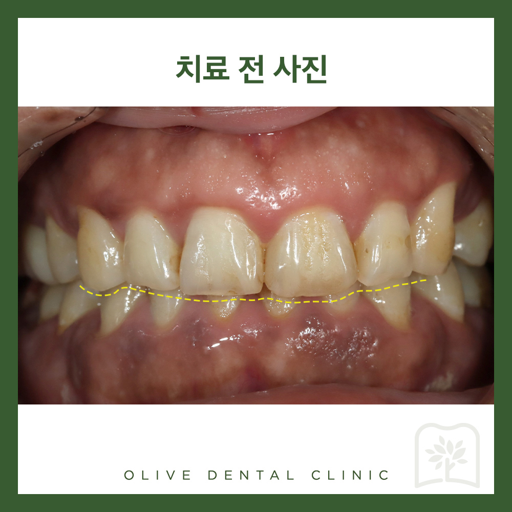 올리브치과 미니쉬솔루션