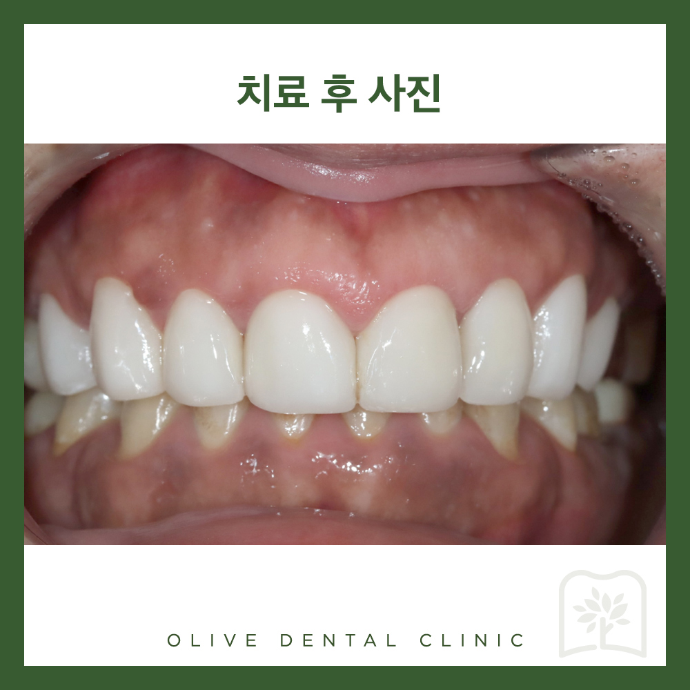 올리브치과 미니쉬솔루션