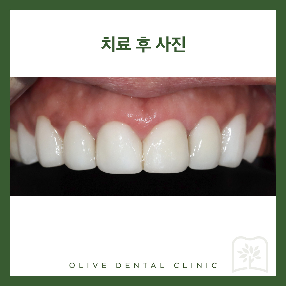 올리브치과 미니쉬솔루션