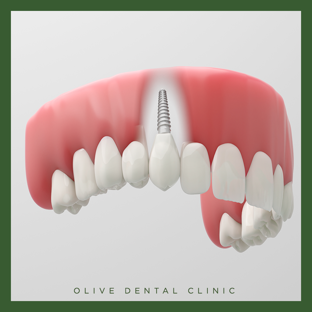 올리브치과 임플란트