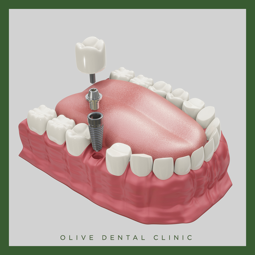 올리브치과 임플란트