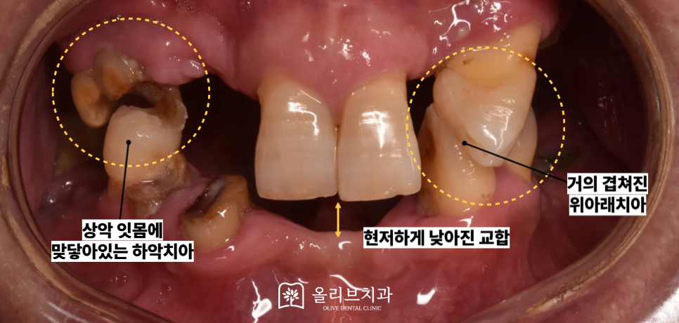 비산동임플란트