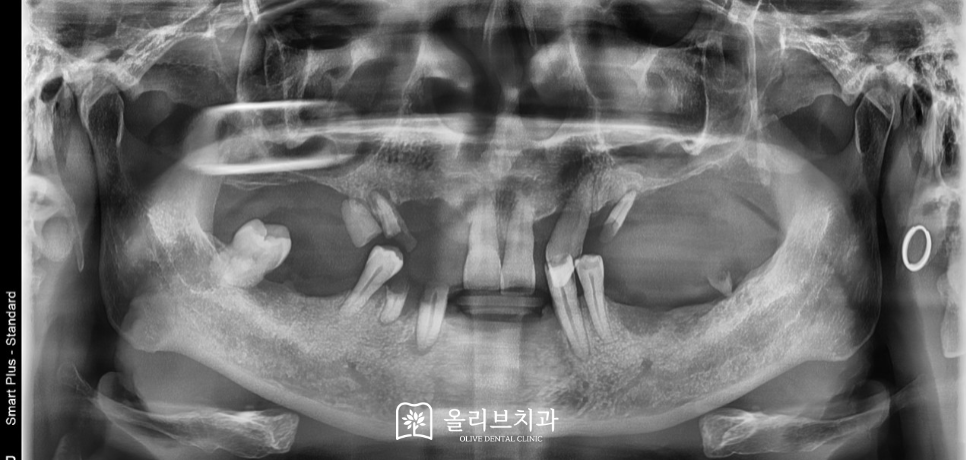 비산동임플란트