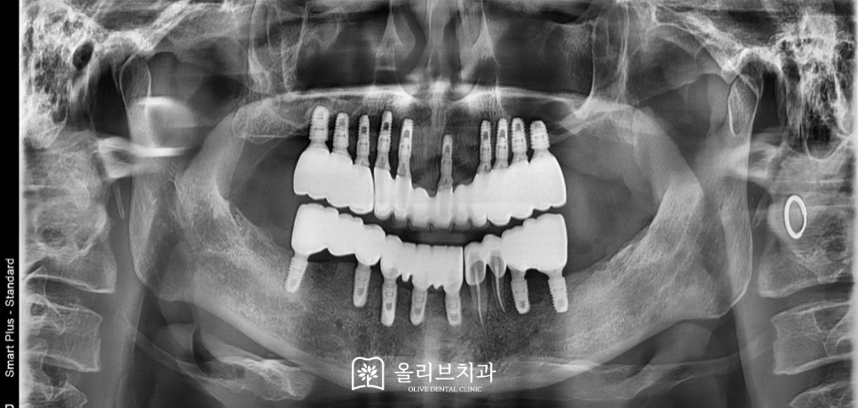 비산동임플란트