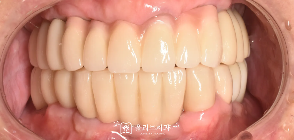 비산동임플란트