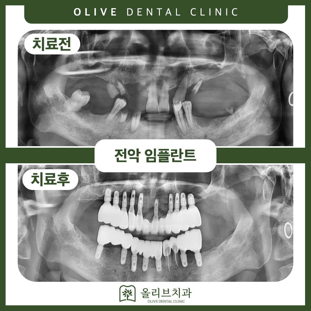 비산동임플란트