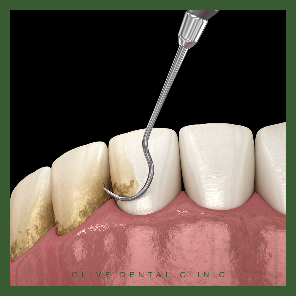 비산동스케일링