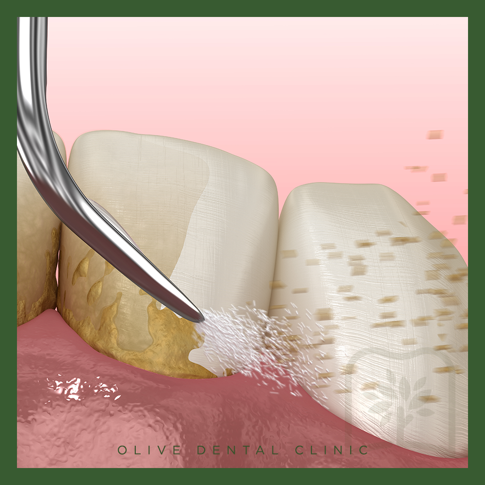 비산동스케일링