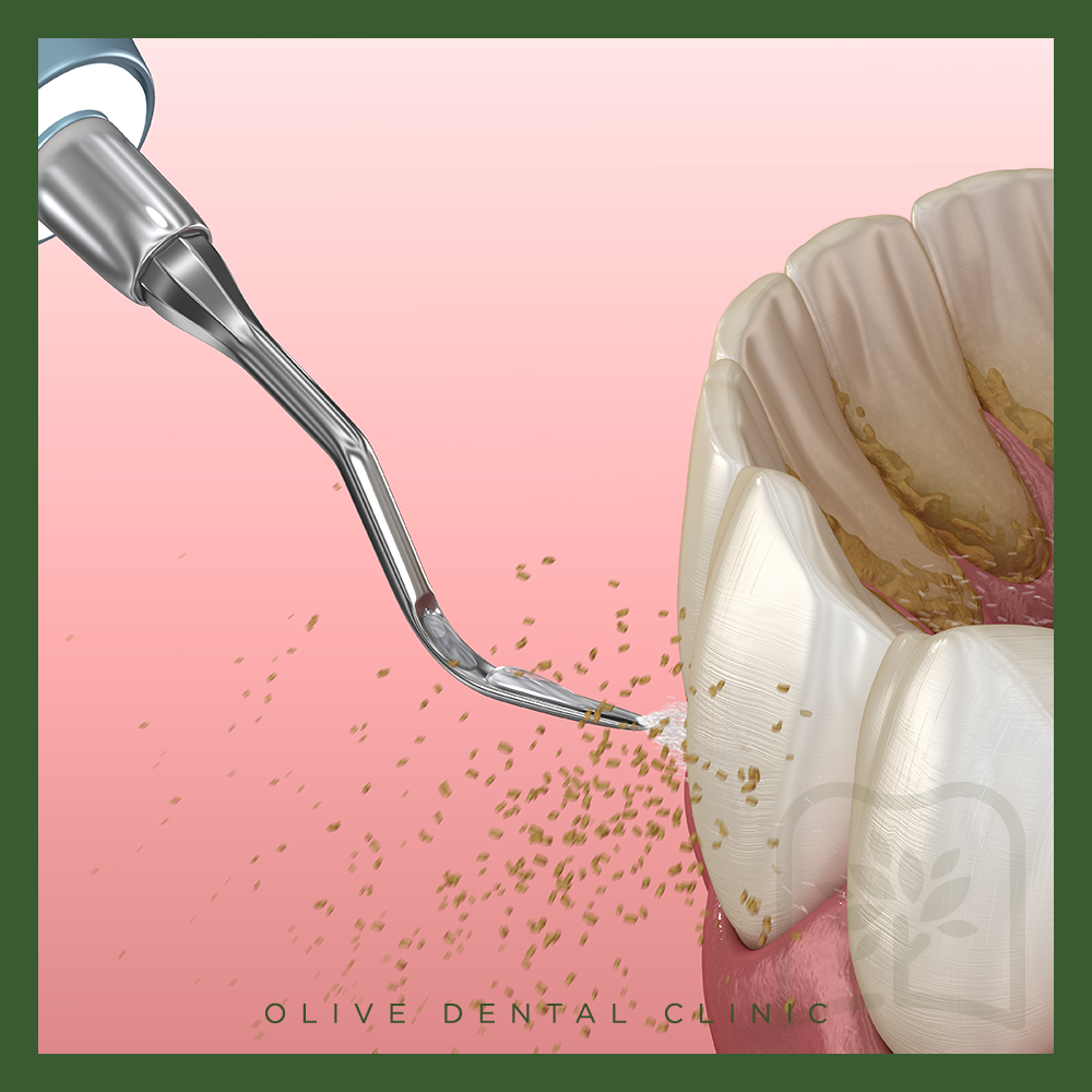 비산동스케일링