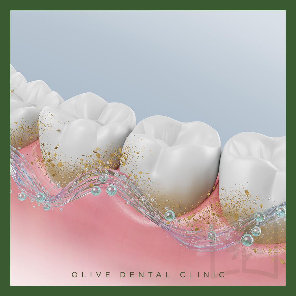 비산동스케일링