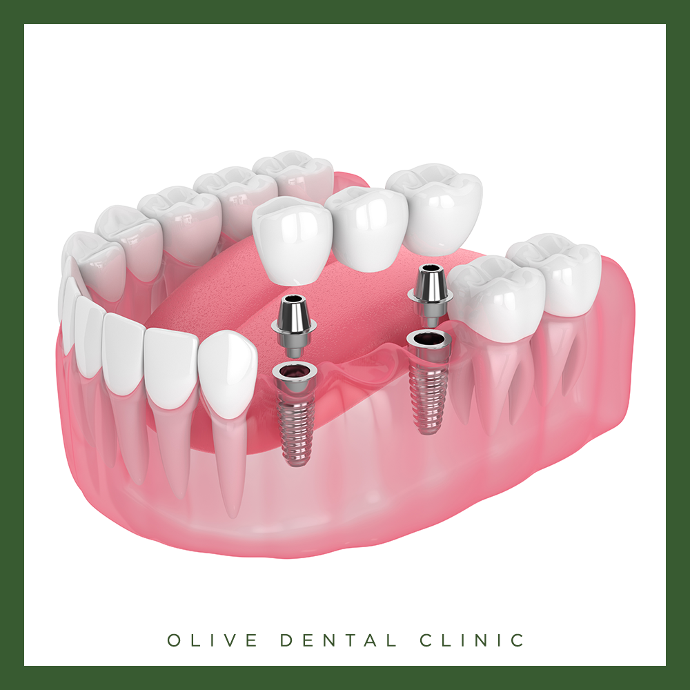 65세 이상 임플란트