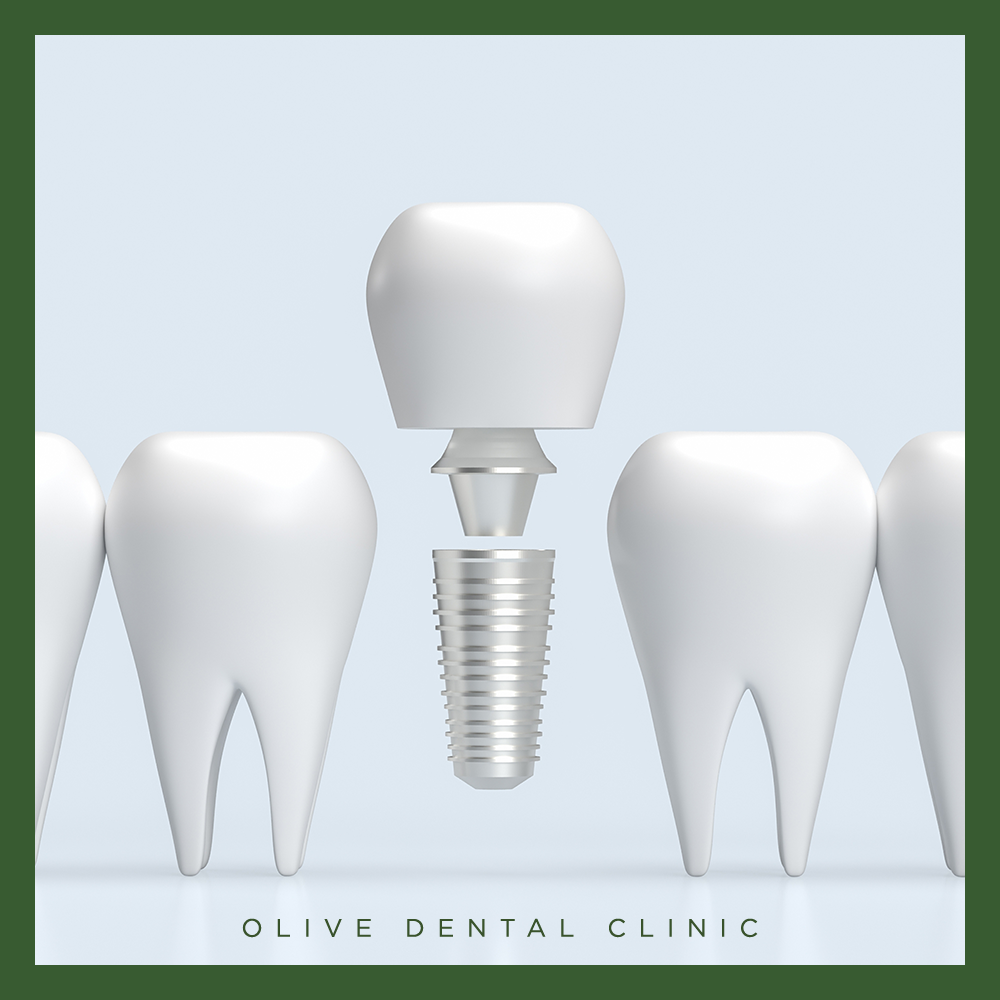 비산동임플란트
