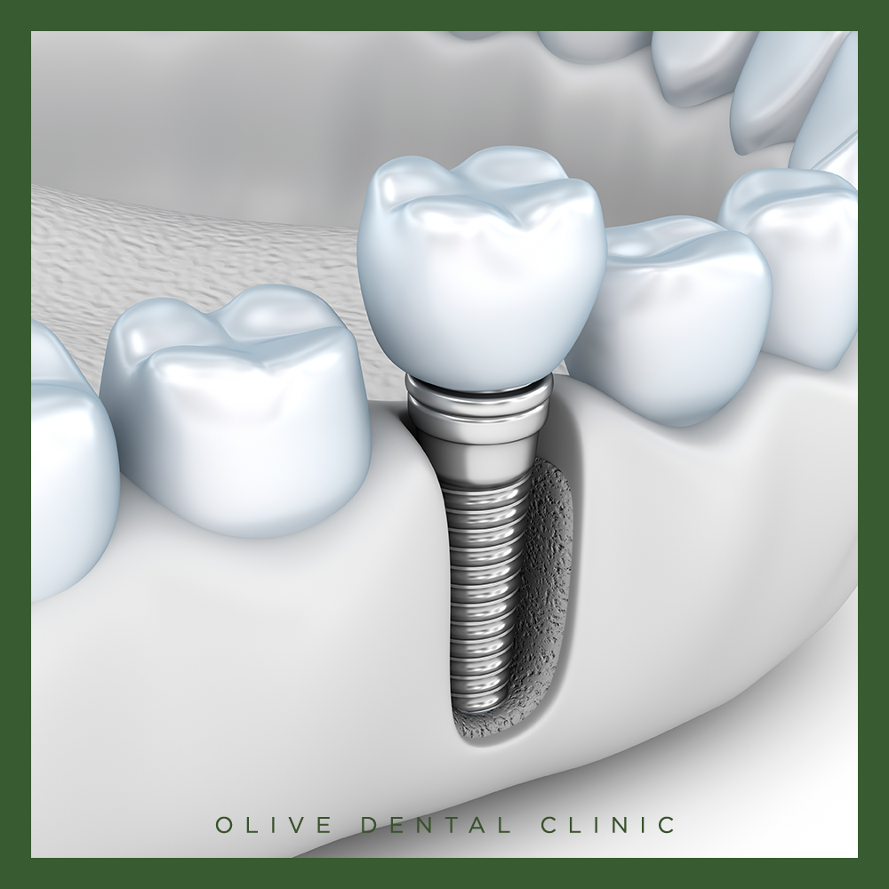 65세 이상 임플란트