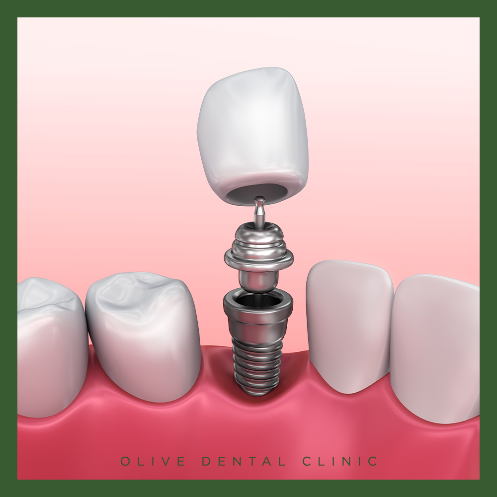 65세 이상 임플란트