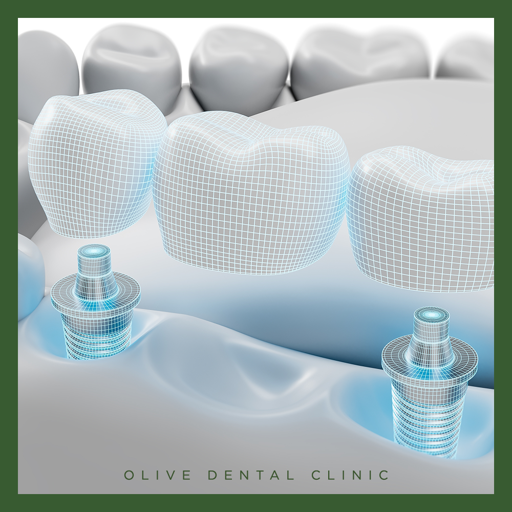 비산동임플란트