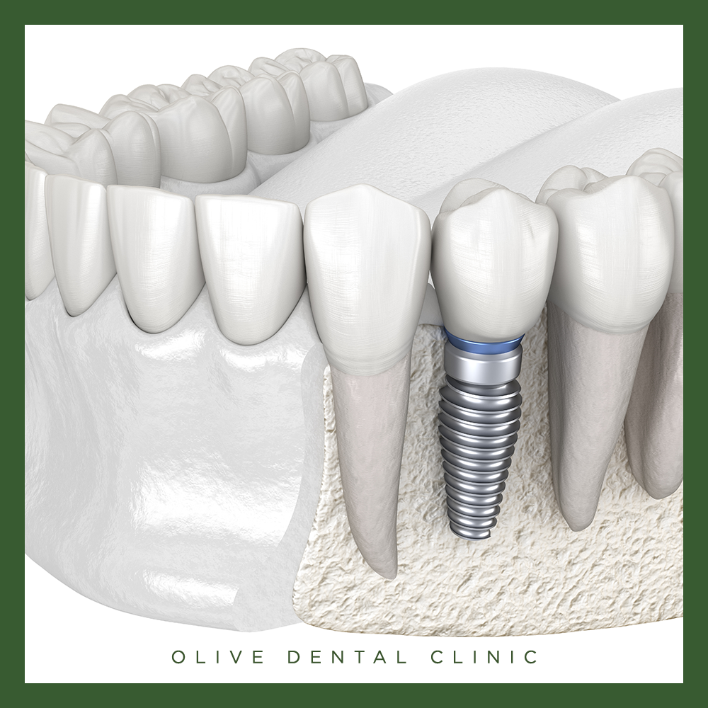 비산동임플란트