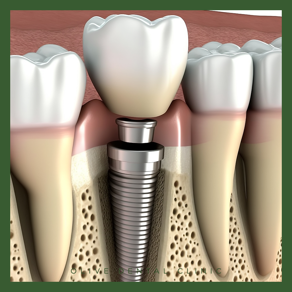 65세 이상 임플란트