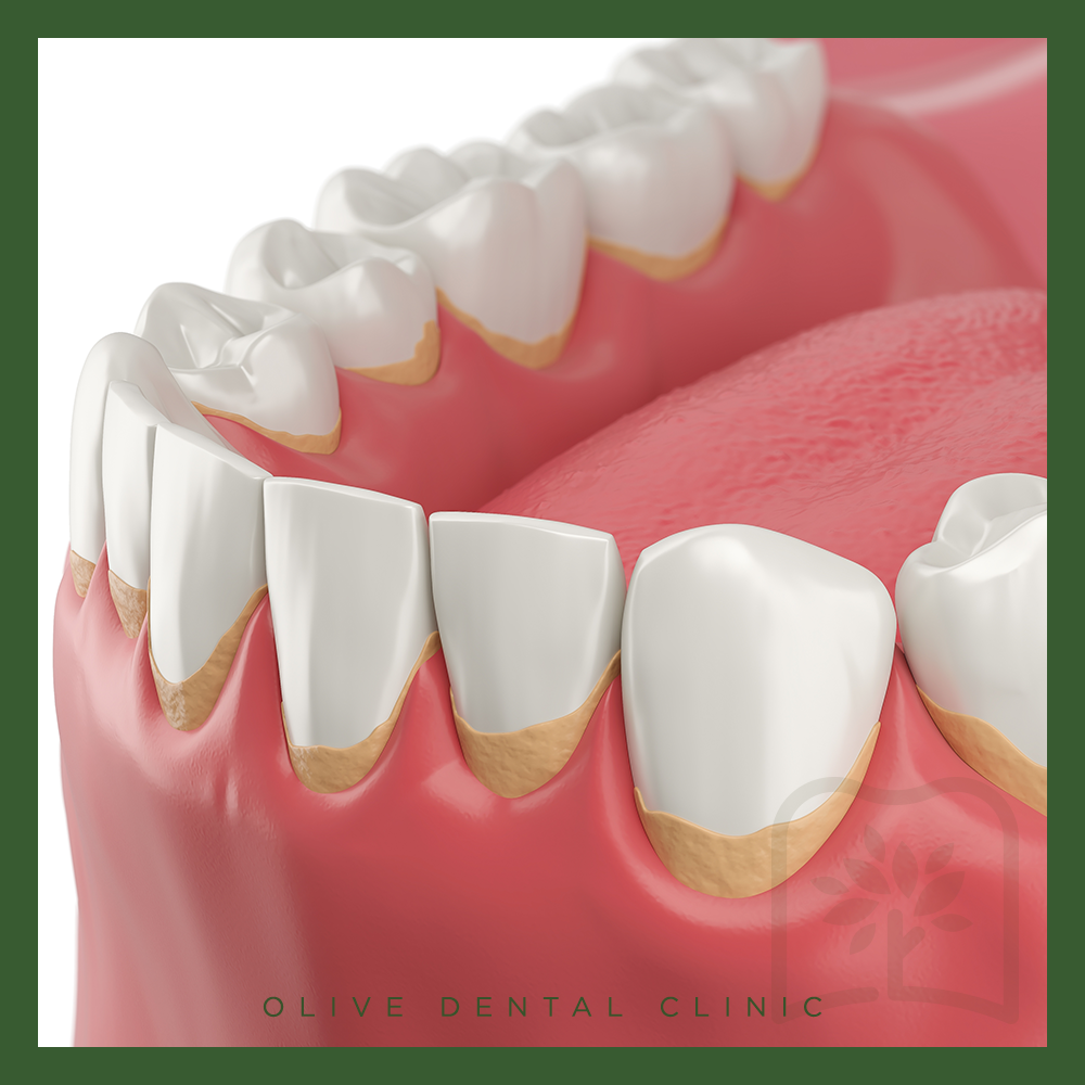 비산동스케일링