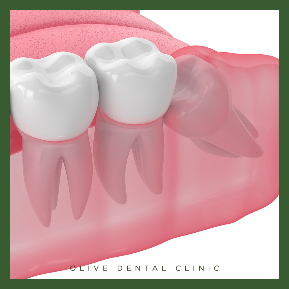 비산동사랑니발치