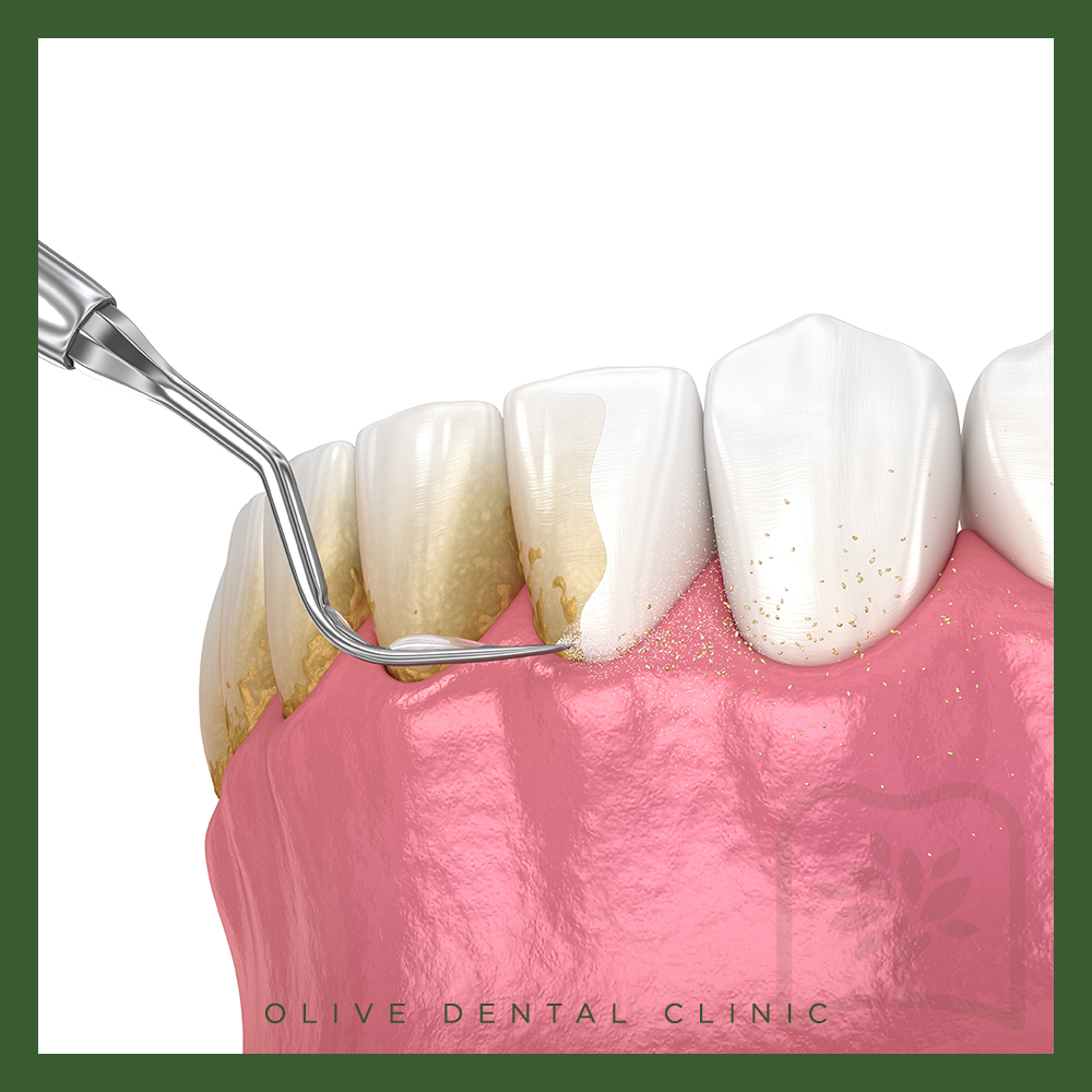 비산동스케일링