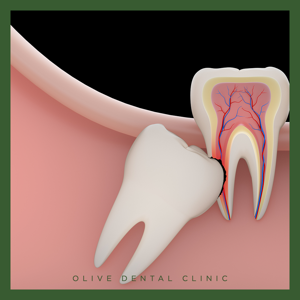 비산동사랑니발치