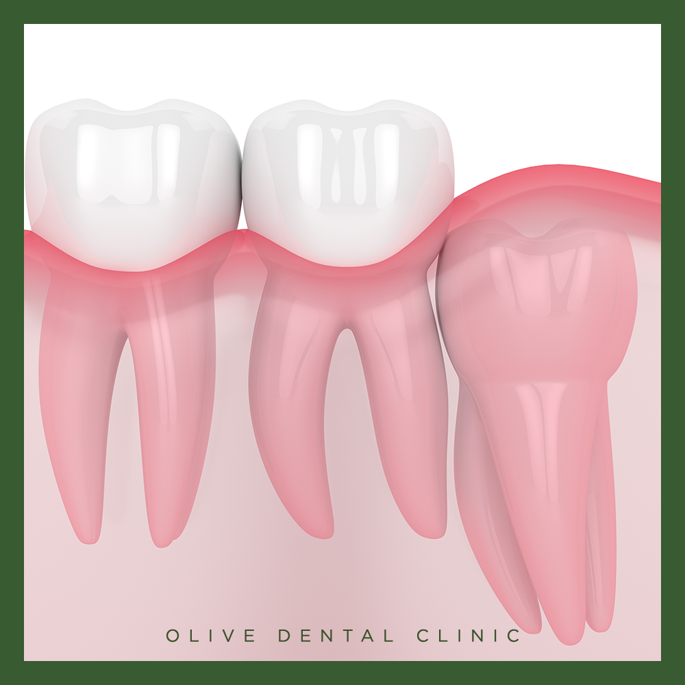 비산동사랑니발치