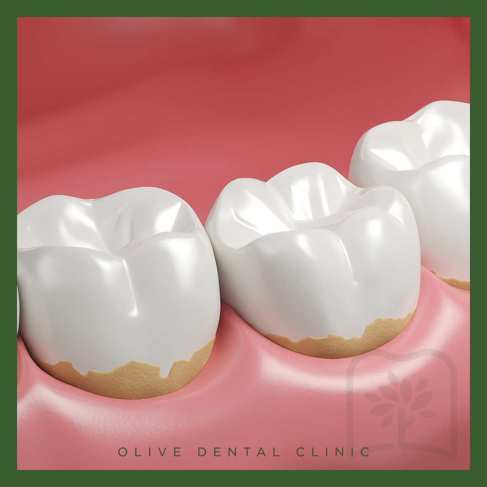 비산동스케일링